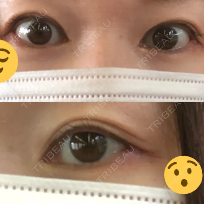 ヒアルロン酸注入（涙袋） Wクリニック 心斎橋院 BEFORE メイン用