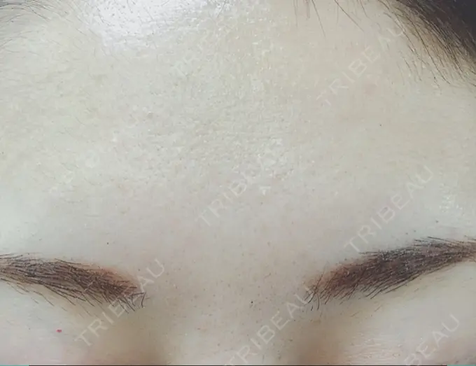 その他（目元） 東京美容外科 秋田院 BEFORE メイン用