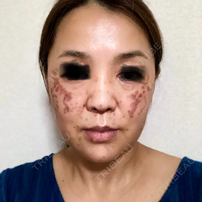 シミ取りレーザー / ピコレーザートーニング（美白・肝斑） / フラクショナルレーザー（毛穴・ニキビ跡） THE ROPPONGI CLINIC（ザ 六本木クリニック） BEFORE メイン用