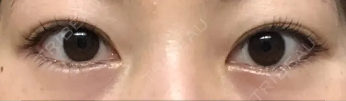 二重切開 城本クリニック 福岡院 BEFORE メイン用