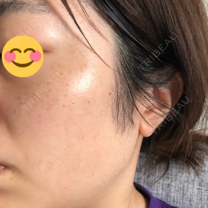 フォトRF ゆり皮膚科 BEFORE メイン用