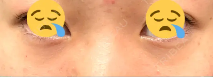 ヒアルロン酸注入（涙袋） / ヒアルロン酸注入（目の下） Wクリニック 心斎橋院 BEFORE メイン用