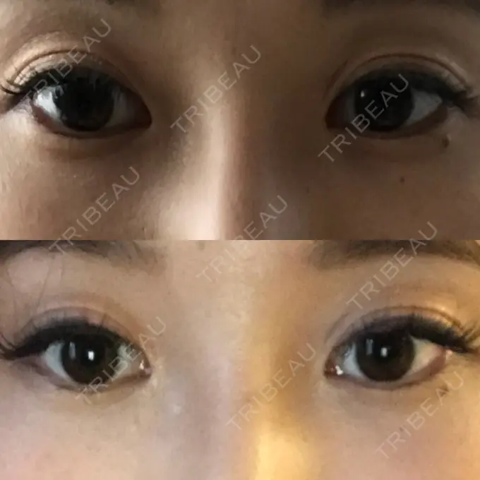 眼瞼下垂（切開） 船橋中央クリニック BEFORE メイン用