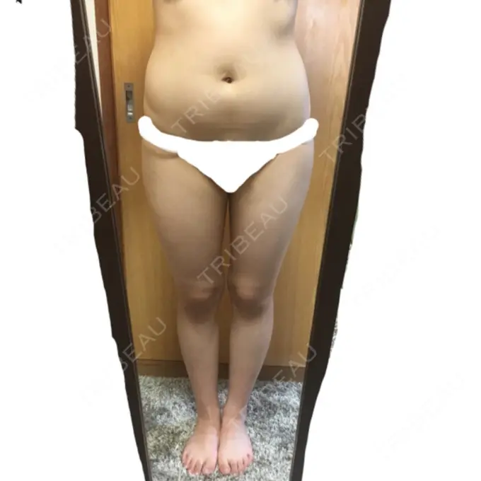 脂肪吸引（脚） / 脂肪吸引（お腹） / 脂肪吸引（お尻） ヨンセスリムライン BEFORE メイン用