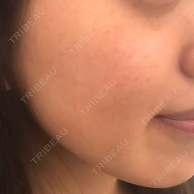 その他（肌） / ダーマペン A CLINIC（エークリニック） 横浜院 BEFORE メイン用