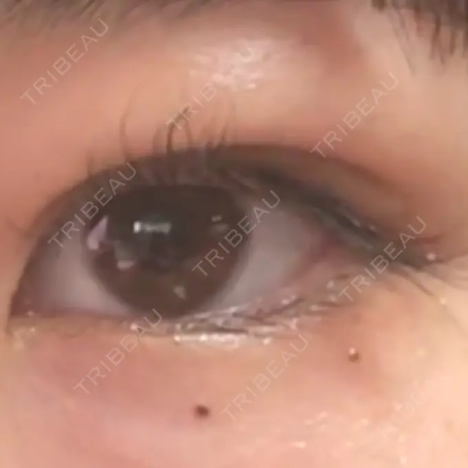 二重埋没 湘南美容クリニック 京都院 BEFORE メイン用