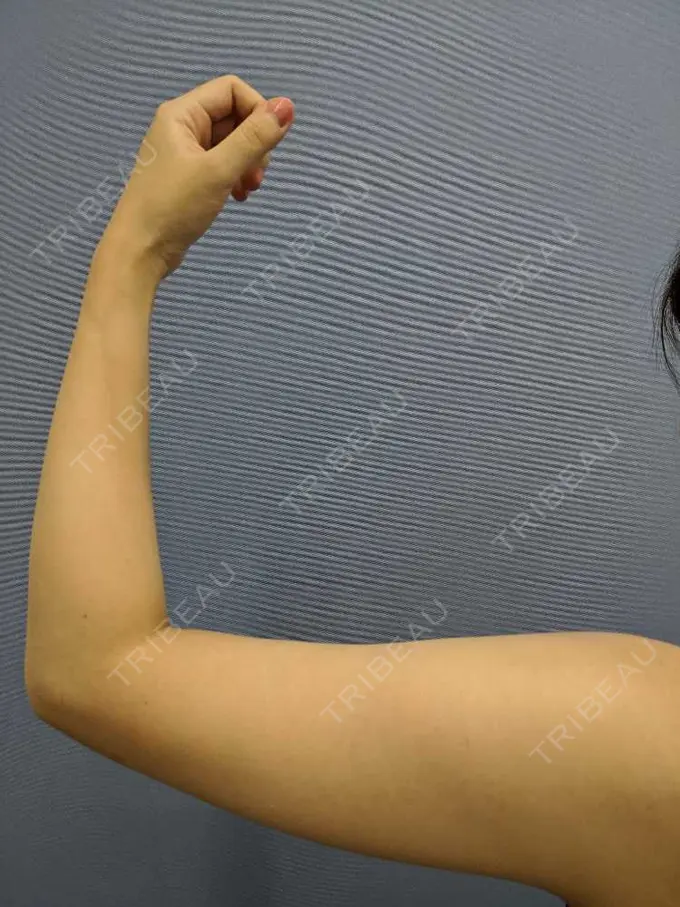 脂肪冷却（輪郭） / その他（ボディ） 湘南美容クリニック 新橋銀座口院 BEFORE メイン用