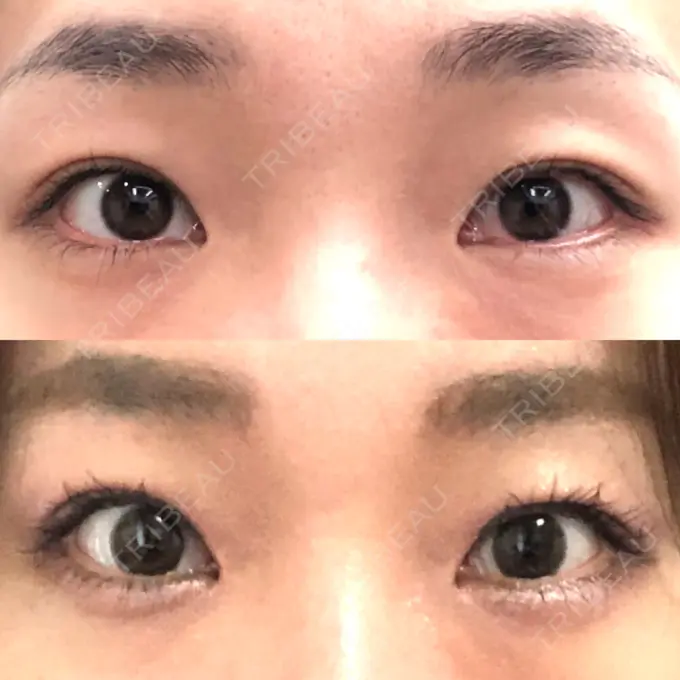 二重切開 / 目頭切開 心斎橋コムロ美容外科クリニック BEFORE メイン用