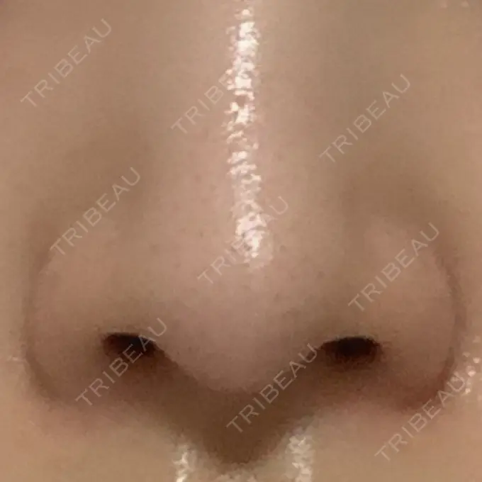 小鼻縮小（切開） / 鼻翼挙上 東京形成美容外科 船橋院 BEFORE メイン用