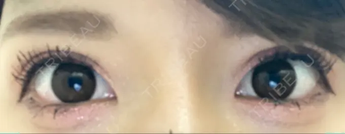 目頭切開 湘南美容クリニック 自由が丘院 BEFORE メイン用