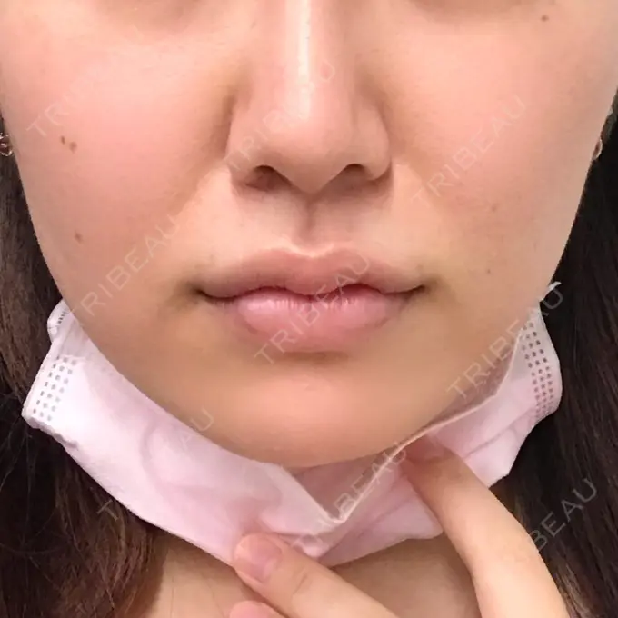 その他（肌） A CLINIC（エークリニック） 横浜院 BEFORE メイン用