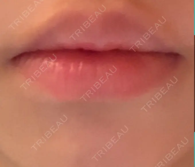 口角挙上 新宿ラクル美容外科クリニック 新宿院 BEFORE メイン用