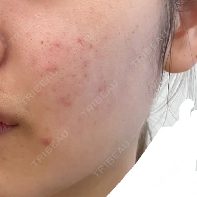 ニキビ治療 / その他 A CLINIC（エークリニック） 横浜院 BEFORE メイン用