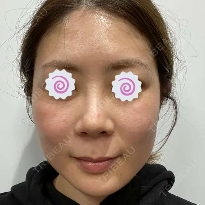 ダーマペン 品川美容外科 品川院 BEFORE メイン用