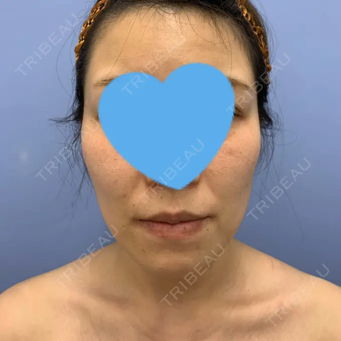 糸リフト / バッカルファット除去 / 脂肪吸引（顔） / メーラーファット除去 / ボトックス（エラ・小顔） 湘南美容クリニック 秋葉原院 BEFORE メイン用