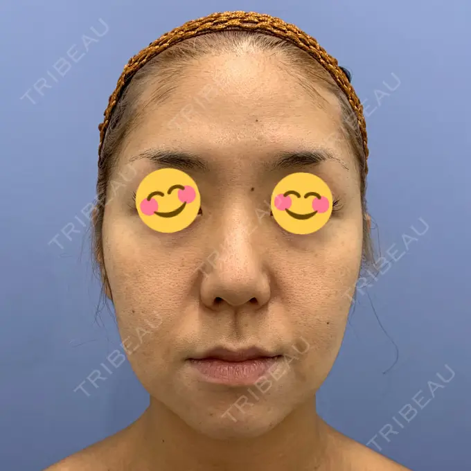 糸リフト / クマ治療 / バッカルファット除去 / 脂肪吸引（顔） / 下まぶたの脂肪取り / メーラーファット除去 湘南美容クリニック 秋葉原院 BEFORE メイン用