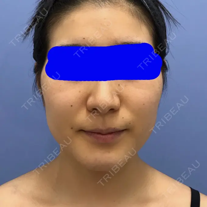 糸リフト / 脂肪吸引（顔） / メーラーファット除去 / ボトックス（エラ・小顔） 湘南美容クリニック 秋葉原院 BEFORE メイン用