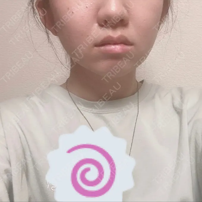 糸リフト / 肌ヒアルロン酸注入（たるみ・シワ改善） / ボトックス（エラ・小顔） TCB東京中央美容外科 新宿東口院 BEFORE メイン用