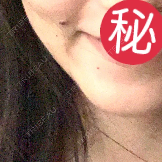 ほくろ・いぼ切除（肌） 医療法人美彩会 グランクリニック BEFORE メイン用