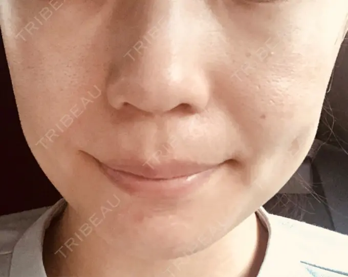 ボトックス（エラ・小顔） パールスキンクリニック天神 BEFORE メイン用