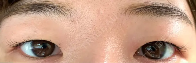 上まぶたの脂肪取り / 眉下切開 城本クリニック 福岡院 BEFORE メイン用