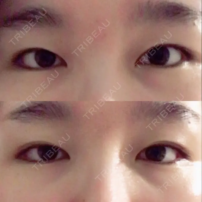 二重埋没 湘南美容クリニック 大阪あべの院 BEFORE メイン用