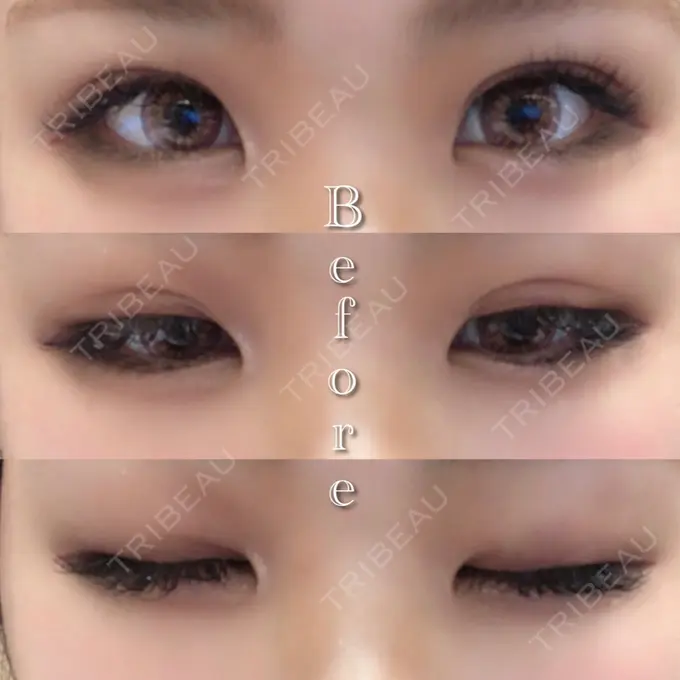 目尻切開 湘南美容クリニック 橋本院 BEFORE メイン用