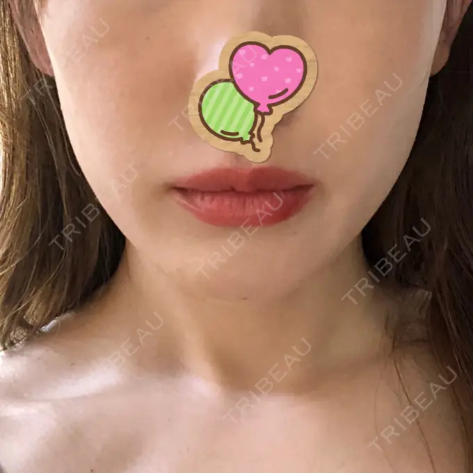 糸リフト / ヒアルロン酸注入（あご） / ボトックス（エラ・小顔） / 脂肪溶解注射（顔） 大阪TAクリニック BEFORE メイン用