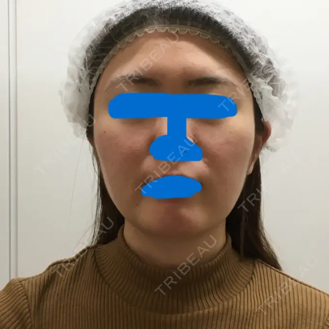 ハイフ（顔） 湘南美容クリニック 新宿本院 BEFORE メイン用