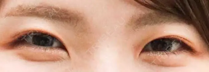 二重埋没 青山セレスクリニック 青山院 BEFORE メイン用