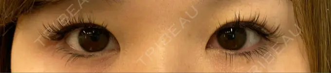 二重埋没 / ヒアルロン酸注入（涙袋） / ヒアルロン酸注入（目の下） 湘南美容クリニック 千葉センシティ院 BEFORE メイン用