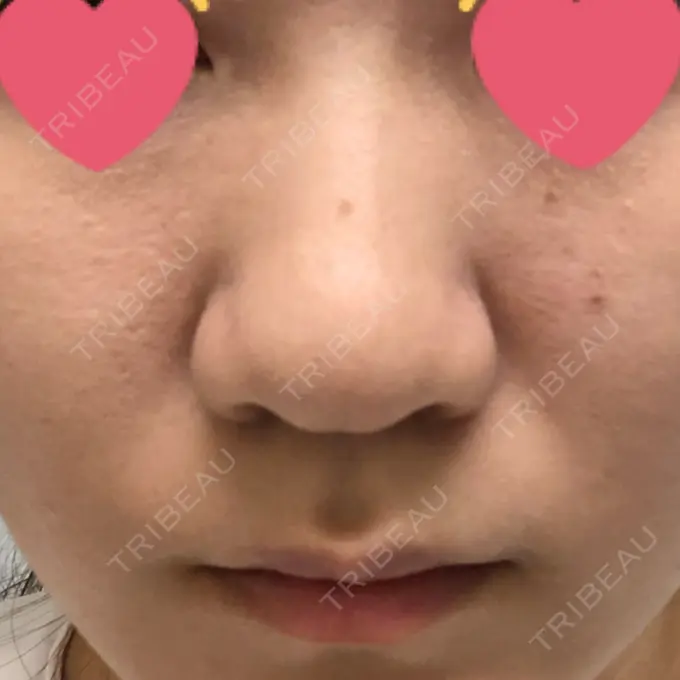 鼻尖形成（切開） / 鼻中隔延長（切開） / 眉間プロテーゼ 湘南美容クリニック 名古屋栄院 BEFORE メイン用