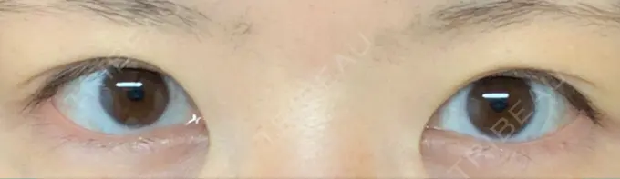 二重切開 / 上まぶたの脂肪取り 城本クリニック 豊橋院 BEFORE メイン用