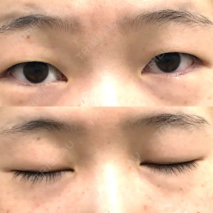 二重切開 ゆめビューティークリニック BEFORE メイン用