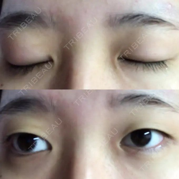 二重埋没 新宿美容外科クリニック 立川院 BEFORE メイン用