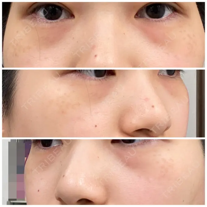 クマ治療 / 下まぶたの脂肪取り / 脂肪注入（輪郭） 湘南美容クリニック 橋本院 BEFORE メイン用