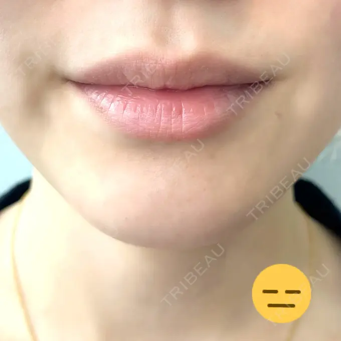 人中短縮 / ヒアルロン酸注入（唇） / ボトックス（口角） アクトリー勝どきウェルネスメディカルクリニック BEFORE メイン用
