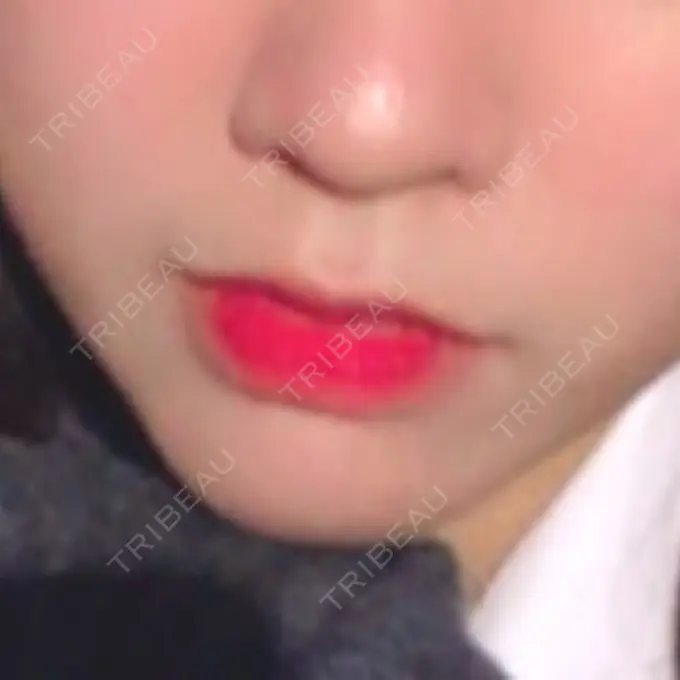 人中短縮 新宿ラクル美容外科クリニック 新宿院 BEFORE メイン用