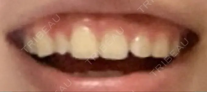 ガミースマイル手術 / その他（口元） / その他（審美歯科/矯正歯科） 南青山矯正歯科 BEFORE メイン用