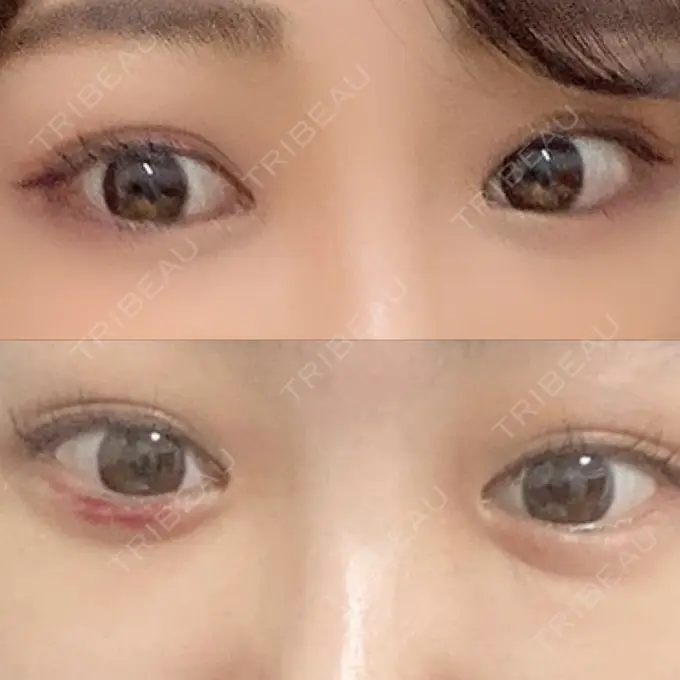 ヒアルロン酸注入（涙袋） 東京皮膚科・形成外科 日本橋院 BEFORE メイン用