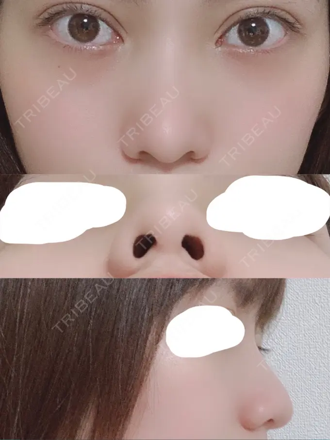 鼻尖形成（切開） / 鼻中隔延長（切開） / 骨切幅寄せ / 鼻修正 湘南美容クリニック 新橋銀座口院 BEFORE メイン用