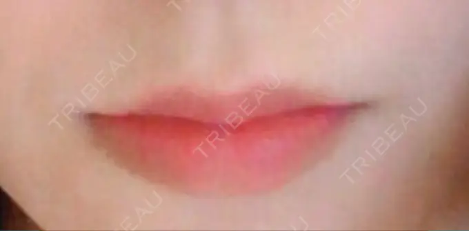 人中短縮 / ヒアルロン酸注入（唇） / ボトックス（口角） ルラ美容クリニック 高田馬場院 BEFORE メイン用