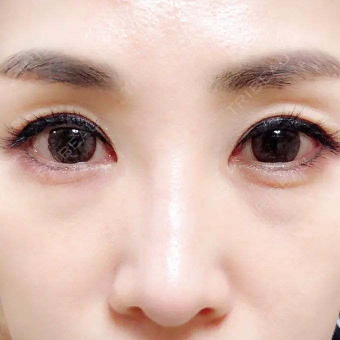 目頭切開 / 目尻切開 / 下まぶたの脂肪取り / タレ目形成・グラマラスライン（切開） / その他（目元） BIANCA銀座 BEFORE メイン用