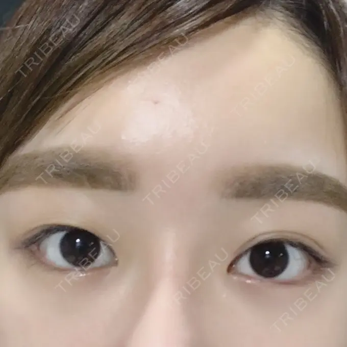 二重切開 / 目頭切開 / 目尻切開 / 上まぶたの脂肪取り / タレ目形成・グラマラスライン（切開） レアート整形外科 BEFORE メイン用