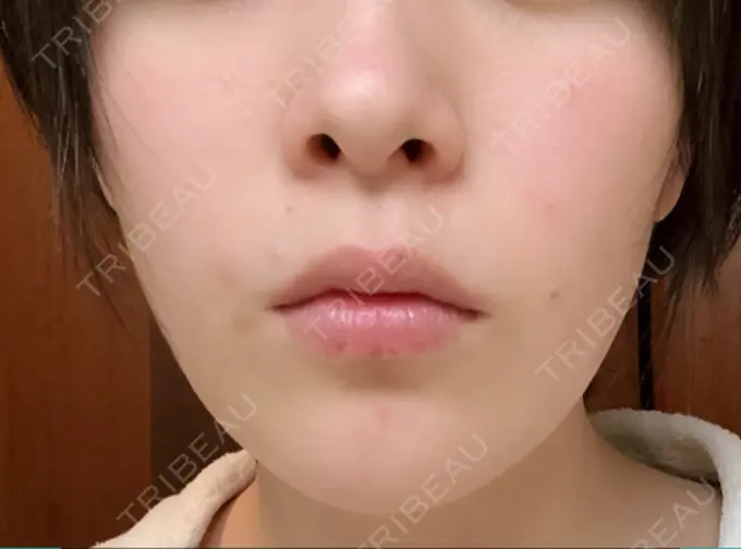 骨切り（あご） 仙台中央クリニック BEFORE メイン用