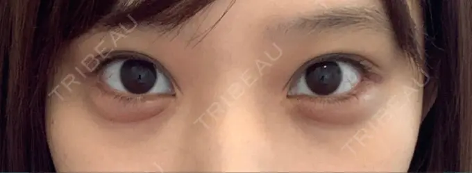 眉下切開 湘南美容クリニック 高田馬場院 BEFORE メイン用