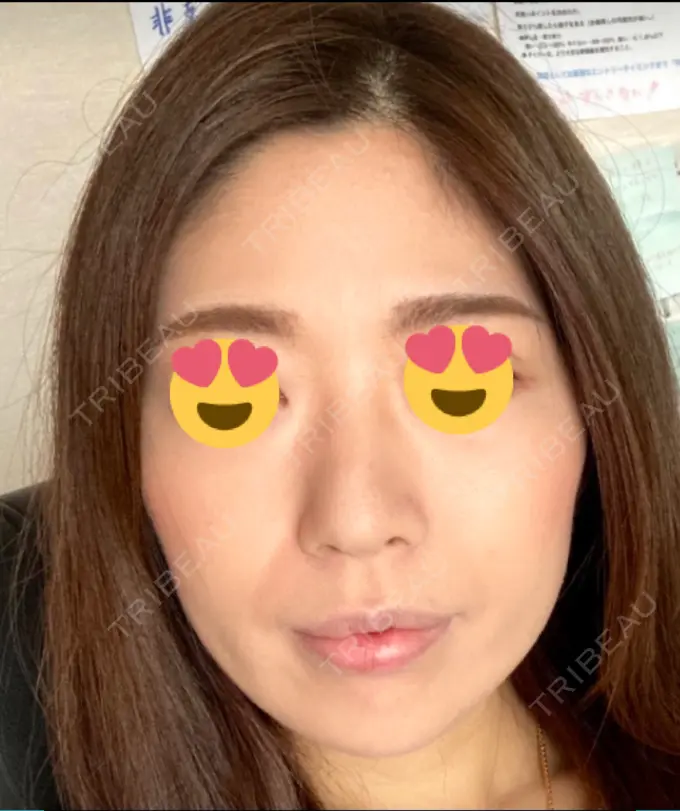 脂肪吸引（顔） ジョウクリニック 大阪院 BEFORE メイン用