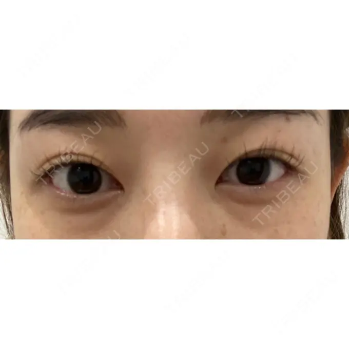 クマ治療 / 下まぶたの脂肪取り ルラ美容クリニック 高田馬場院 BEFORE メイン用