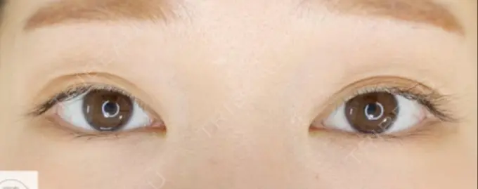 二重埋没 / ヒアルロン酸注入（目の下） EMMA CLINIC（エマクリニック） BEFORE メイン用