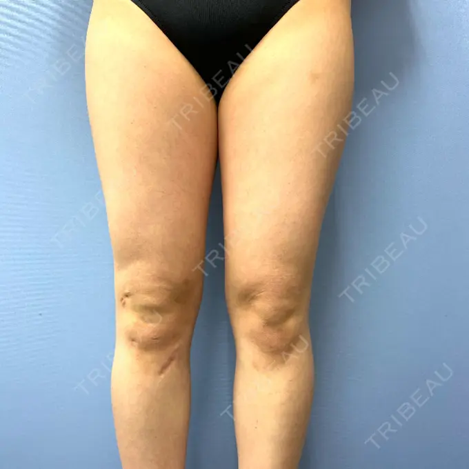 脂肪吸引（脚） 湘南美容クリニック 札幌院 BEFORE メイン用